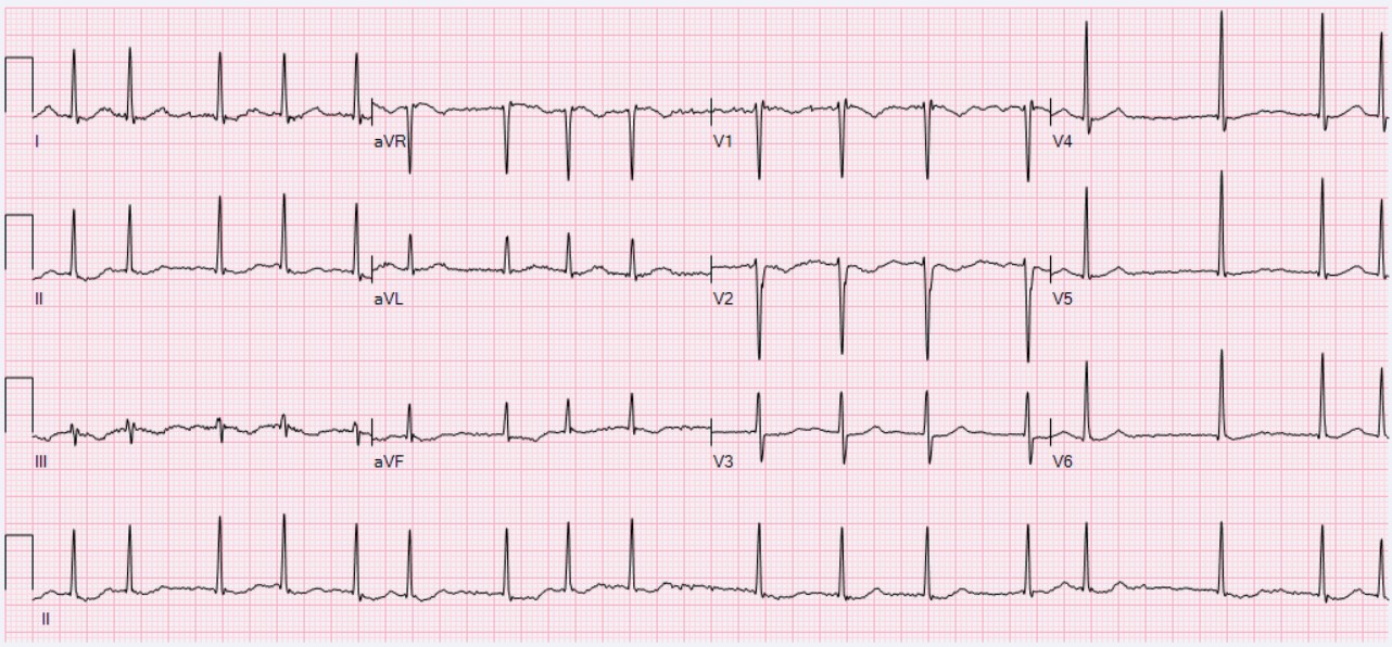A twelve-lead electrocardiogram in atrial fibrillation, with no P wave before the irregular beats.