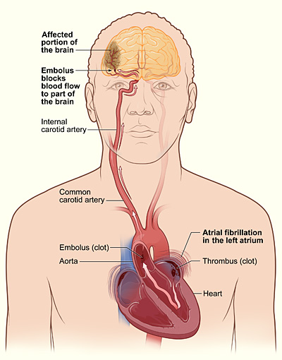 An illustration of a clot forming in the left atrium and travelling up an artery to the brain in atrial fibrillation.