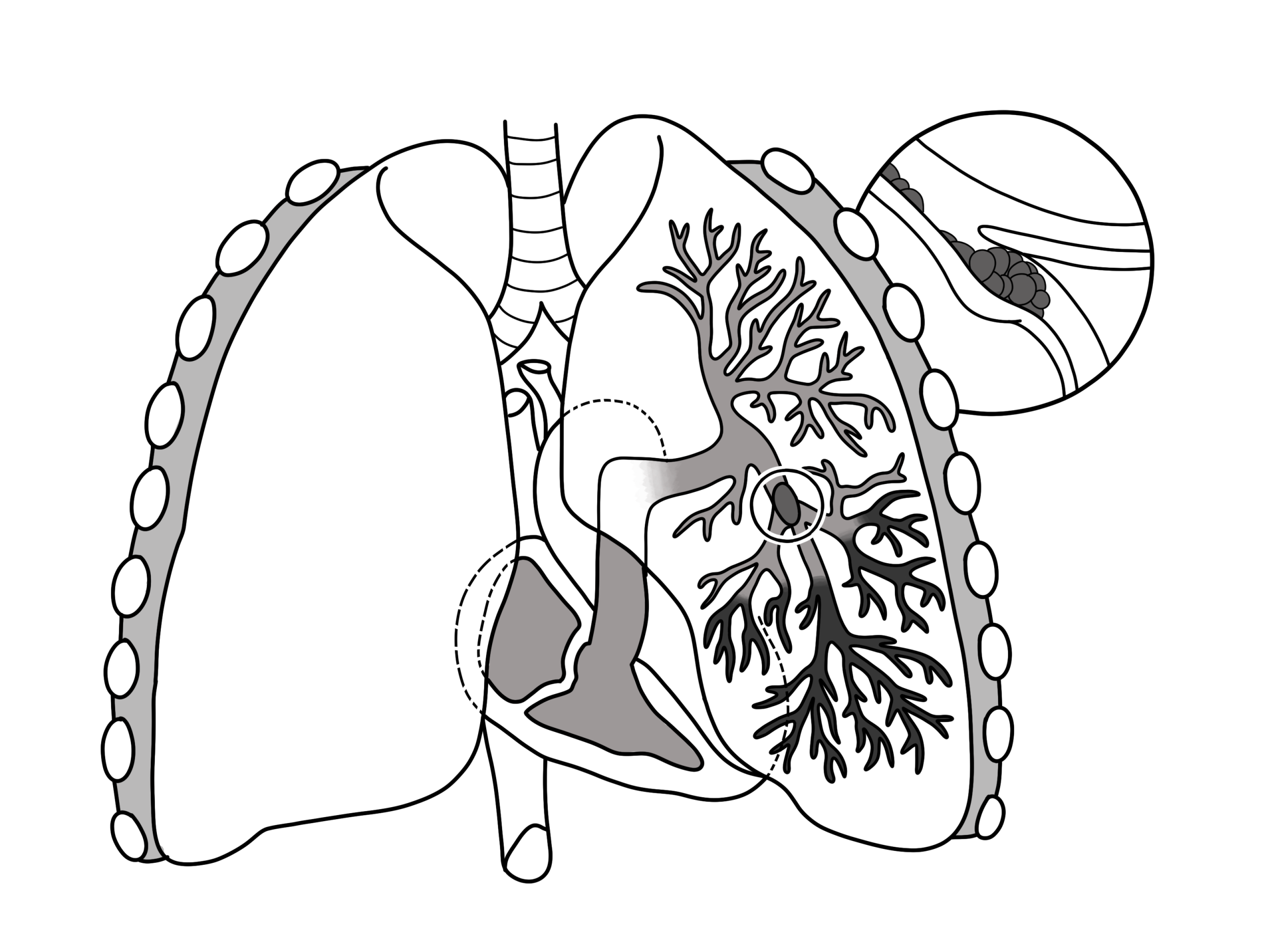 A diagram of a pulmonary embolism, a clot lodged in a branch of the lung artery shown close up in an inset.