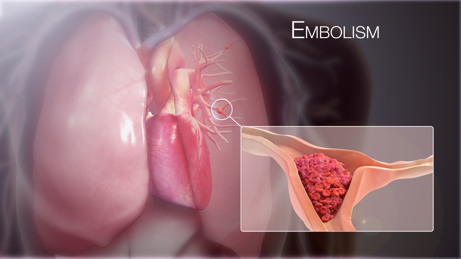 A three-dimensional rendering of the heart and lungs with a clot packed inside a branch of the pulmonary artery.