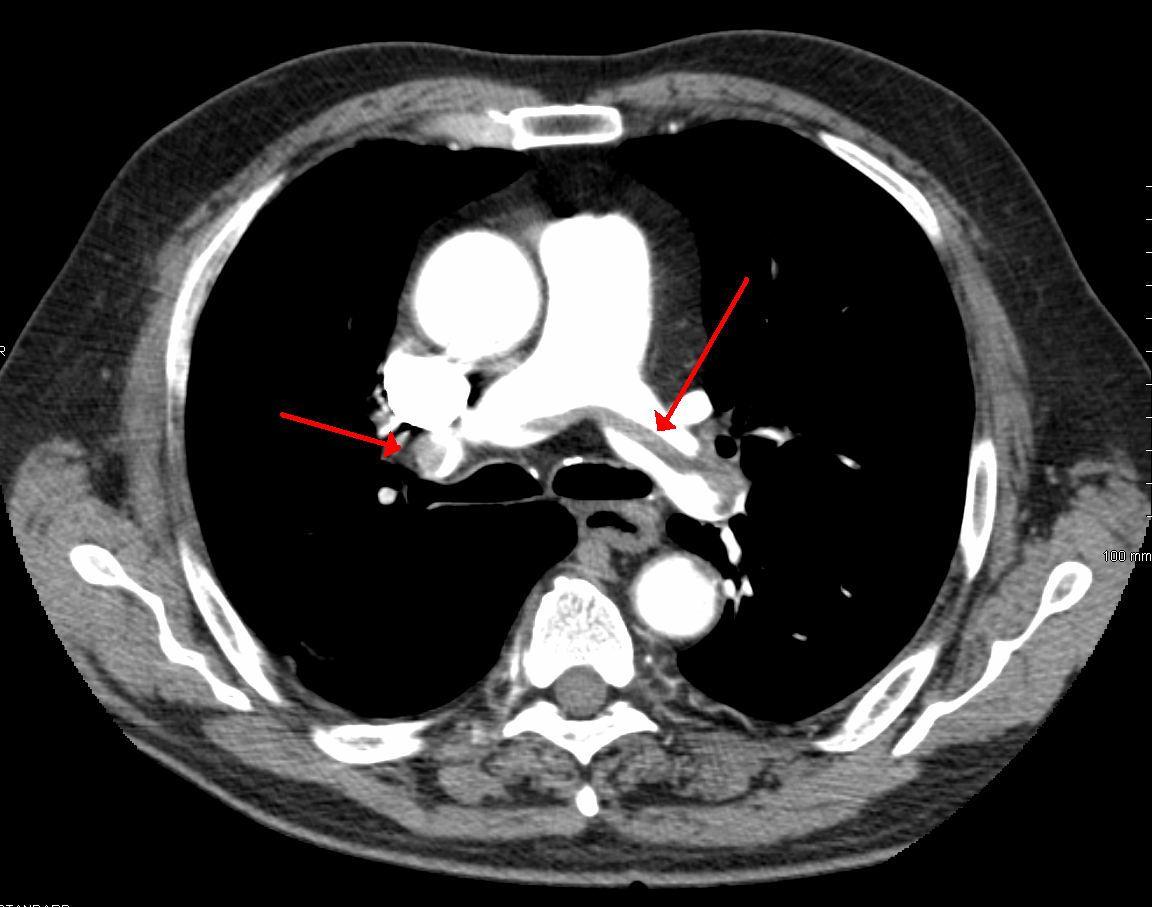 An axial chest CT showing a saddle pulmonary embolism, with arrows marking clot across the pulmonary arteries.