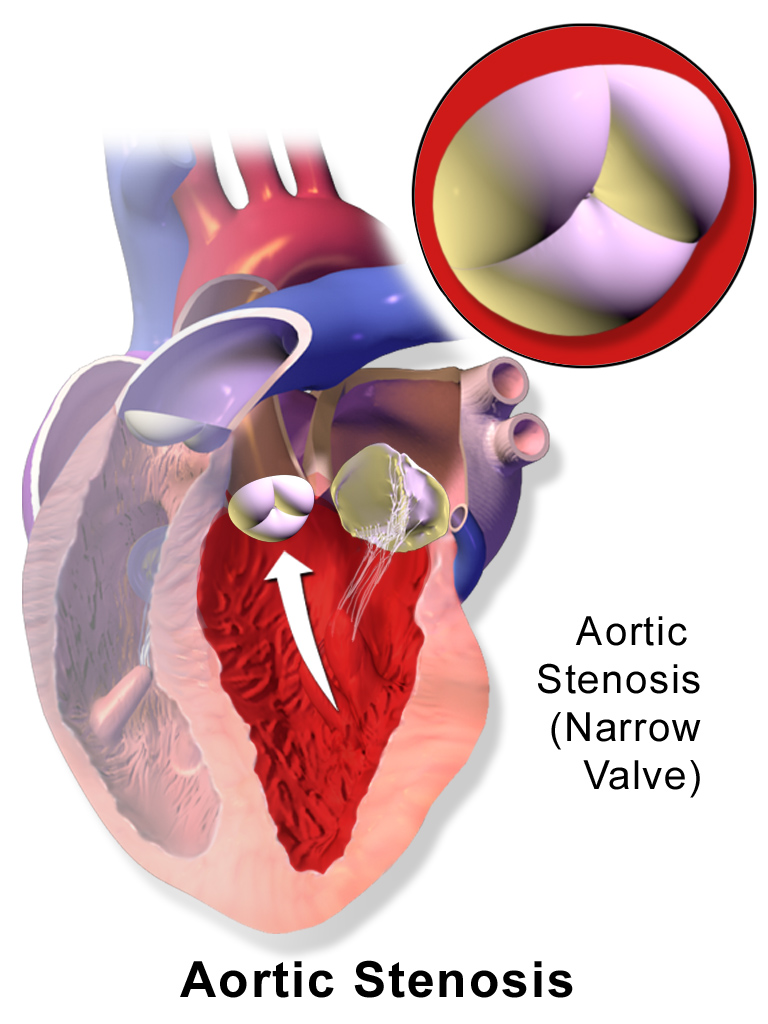A diagram of aortic stenosis, the aortic valve narrowed to a tight opening shown in the inset circle.