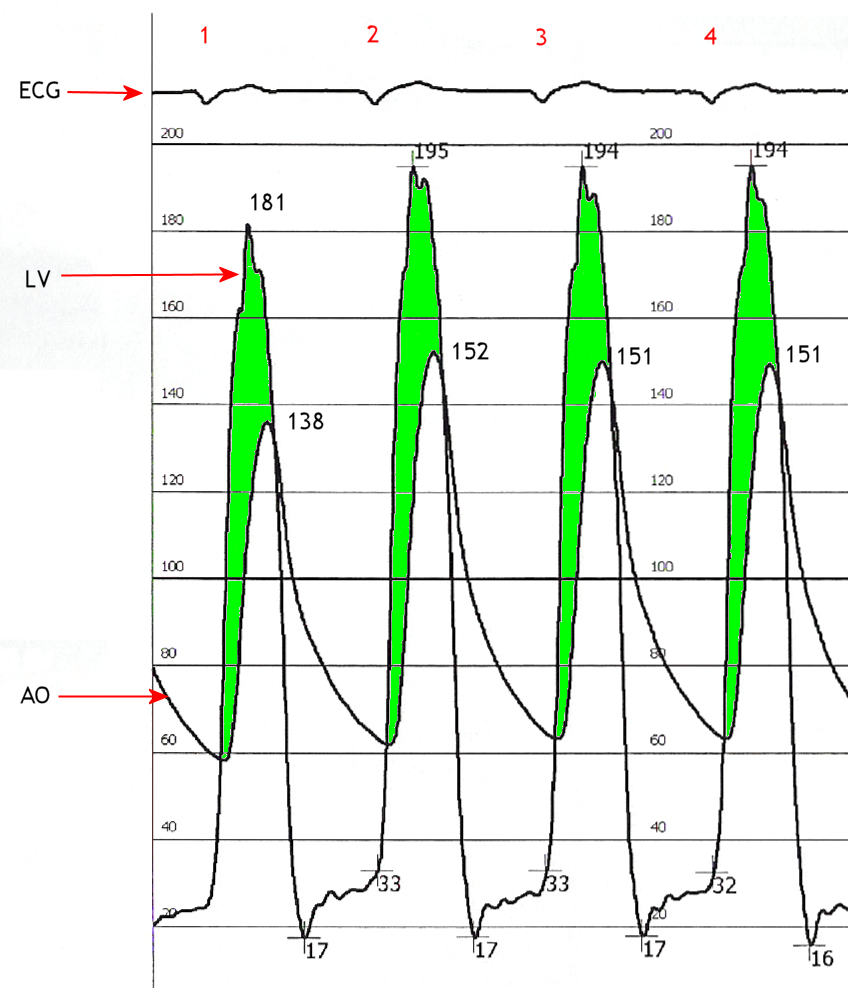Left-ventricular and aortic pressure curves recorded by catheter, the shaded gap between them marking the gradient across a tight aortic valve.