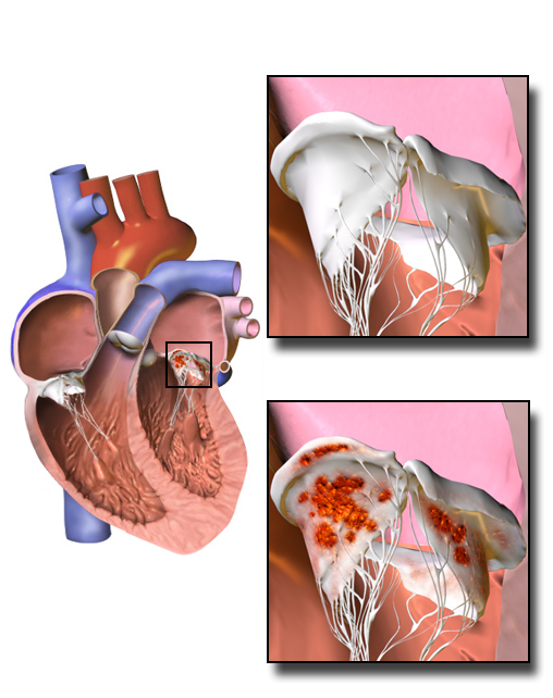 A diagram of the heart with insets of a valve leaflet, the lower inset showing vegetations on the valve.