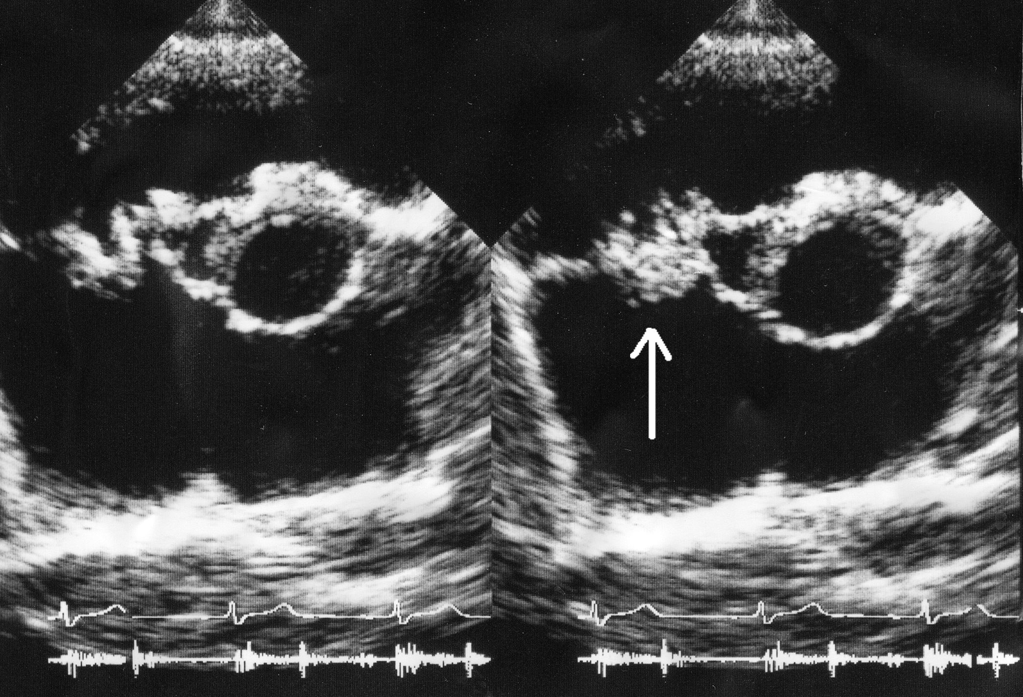 Two echocardiogram frames at the aortic-valve level, an arrow marking a vegetation on the valve in the right frame.