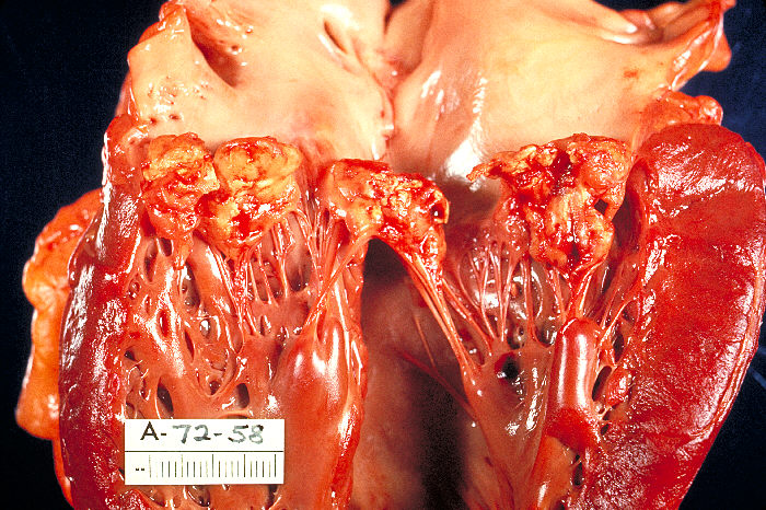 An opened heart showing the mitral valve with cauliflower-like vegetations on the leaflets.