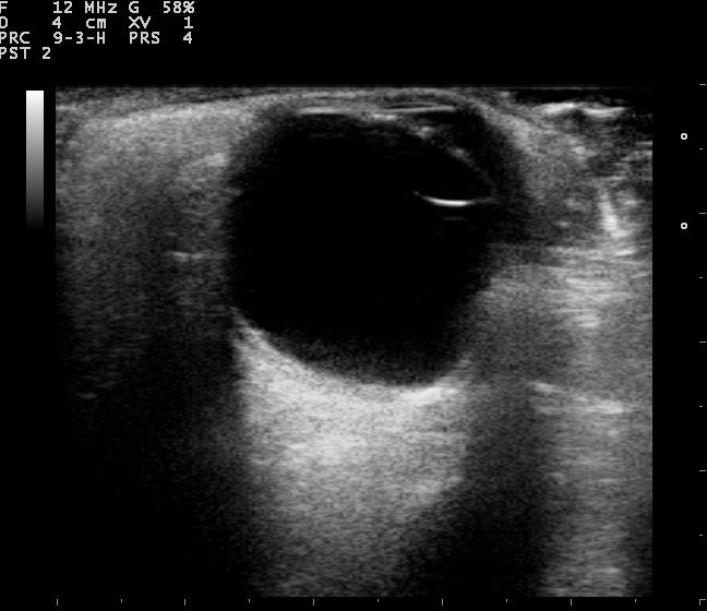 A grayscale B-scan ultrasound of the eye showing the dark vitreous cavity and the lens at the front.
