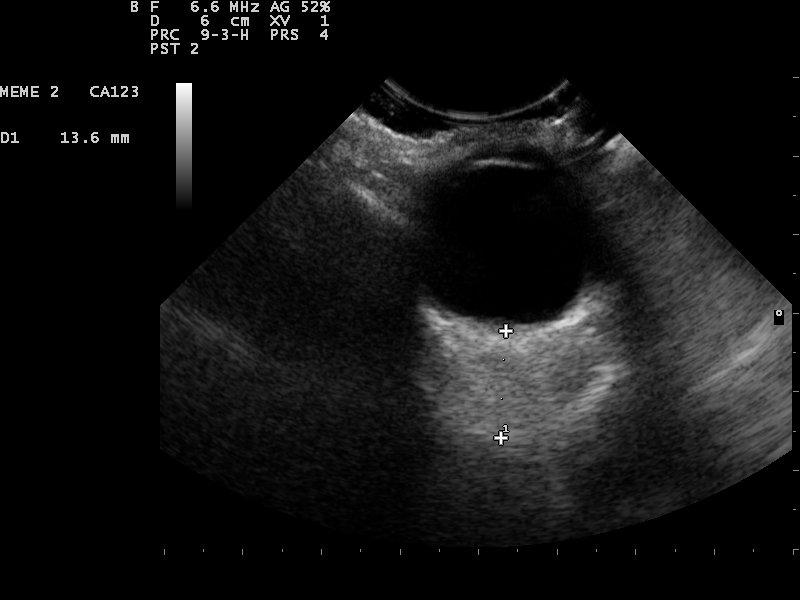 A B-scan ultrasound of the eye with calipers measuring across the dark globe.