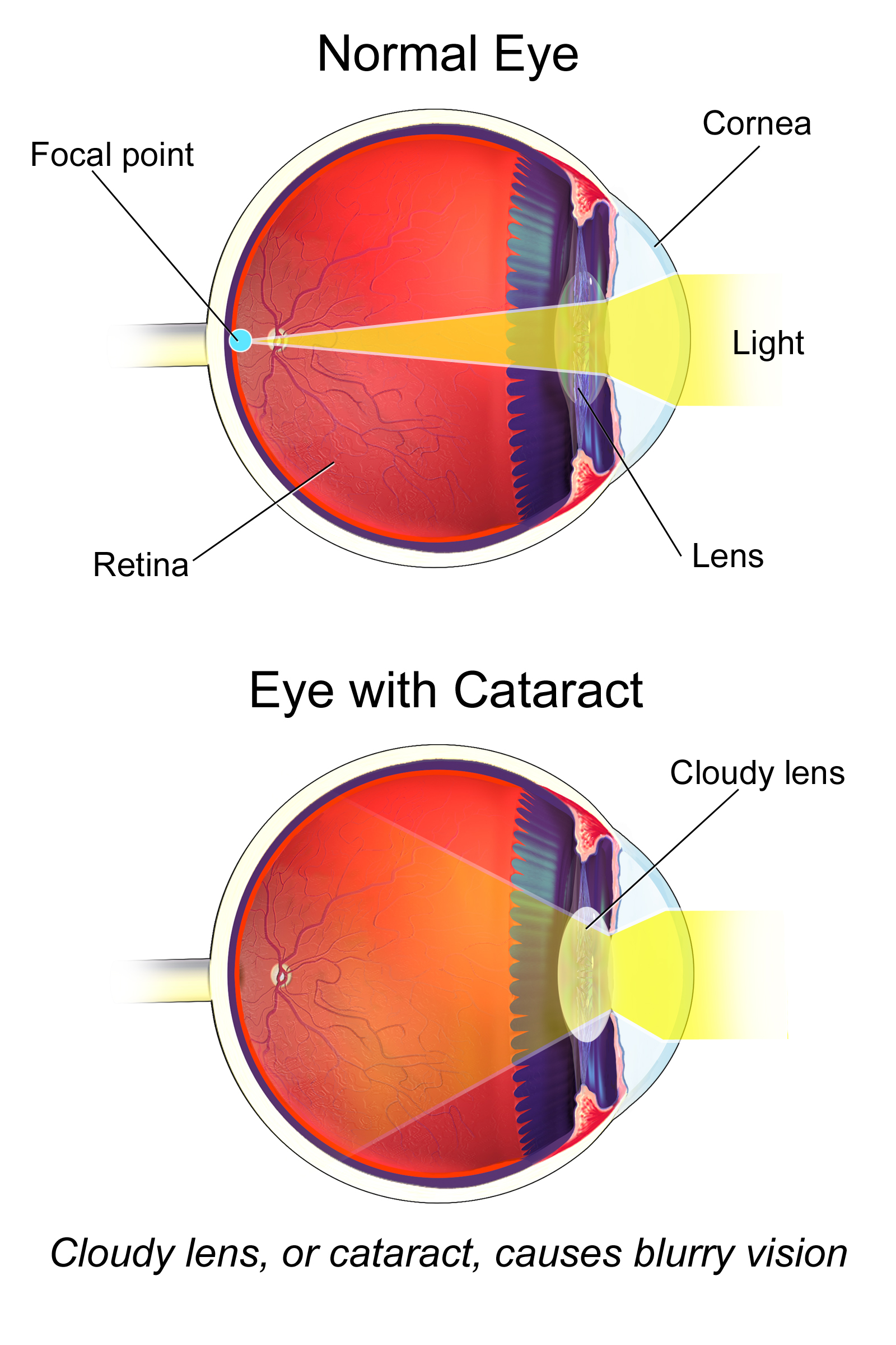 A diagram of a normal eye beside an eye with a cataract, the natural lens gone cloudy.
