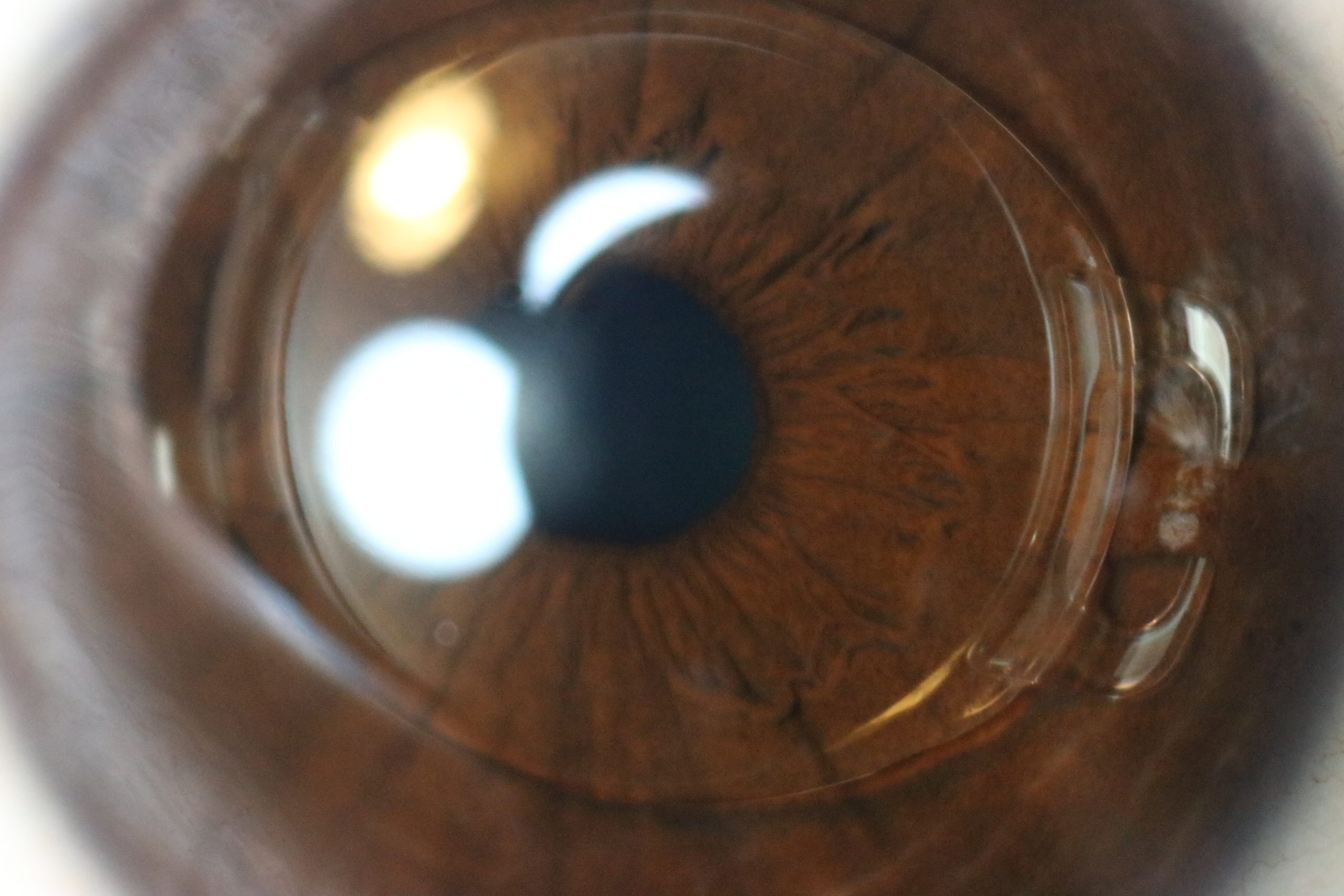A clear plastic intraocular lens implanted inside an eye, seen against a brown iris.