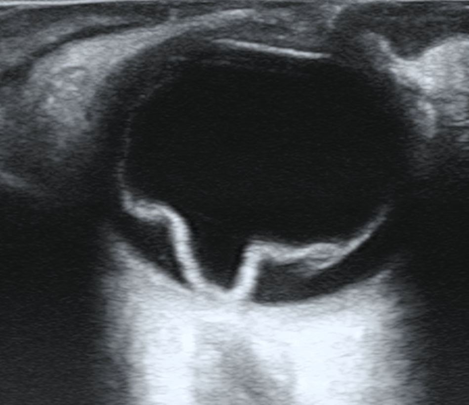 A B-scan ultrasound of the eye showing a bright folded membrane tethered toward the optic nerve.
