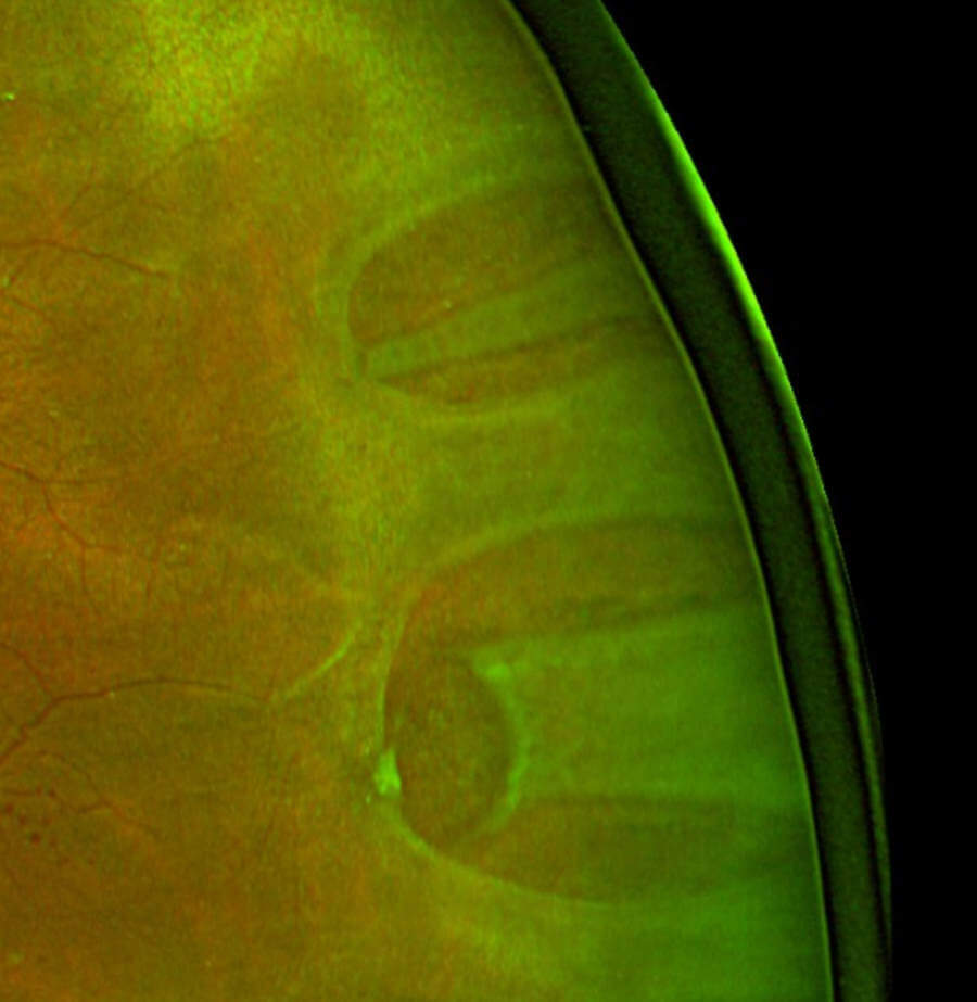 A widefield green-channel fundus photo of a rhegmatogenous retinal detachment.