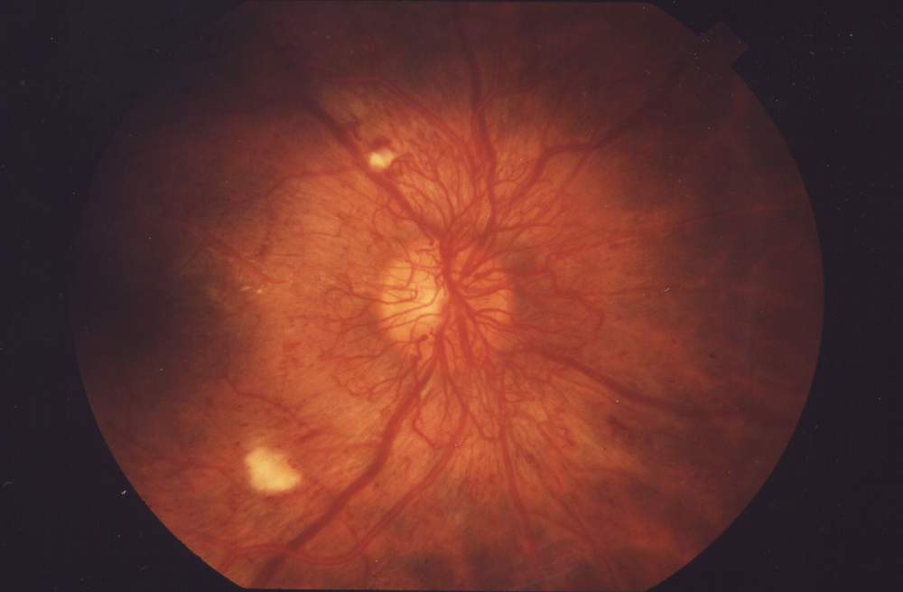 A fundus photograph of proliferative diabetic retinopathy with new vessels near the optic disc.