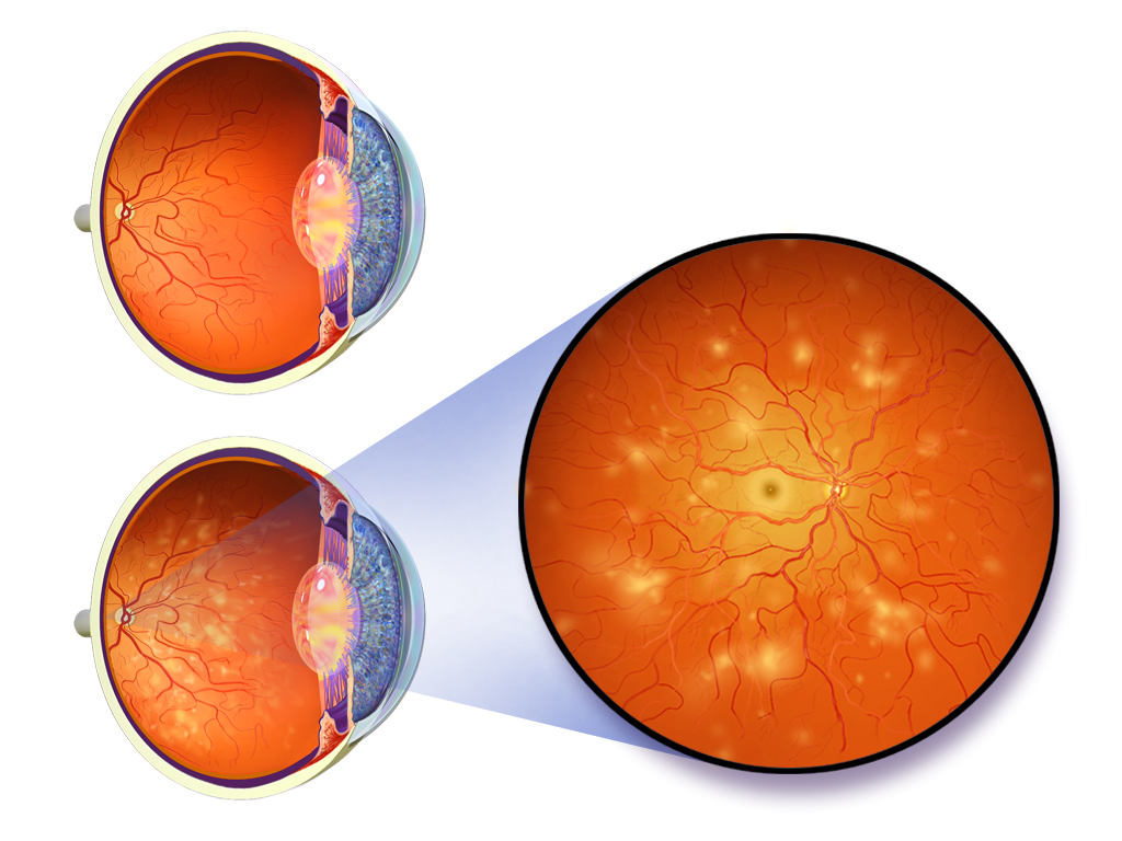 A diagram of diabetic retinopathy showing a normal eye, a diseased eye, and a close-up of the retina.