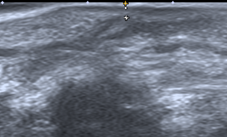 An ultrasound showing a foreign body as a bright echo with a dark acoustic shadow behind it.