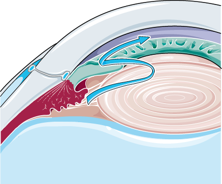 A diagram of angle-closure glaucoma with the iris bowed against the drainage angle and arrows of blocked fluid.