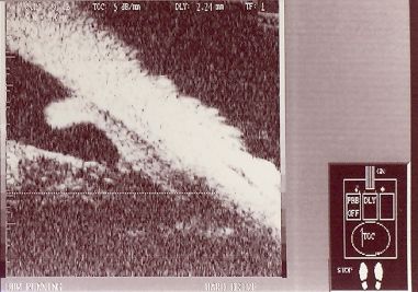 An ultrasound biomicroscopy image of a closed anterior chamber angle.