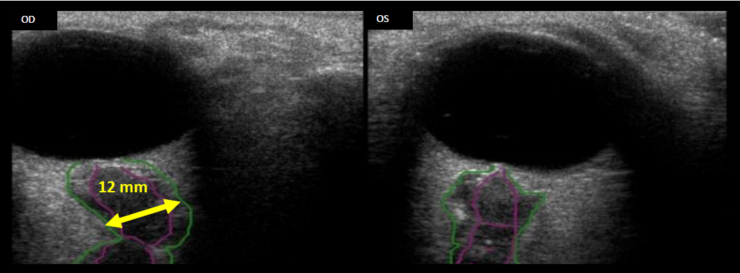 An ultrasound of the optic nerve behind the eye, the dark globe above and the nerve traced in the orbit below.