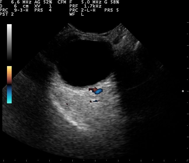 A color Doppler ultrasound of the eye showing red and blue blood flow in a vessel behind the globe.