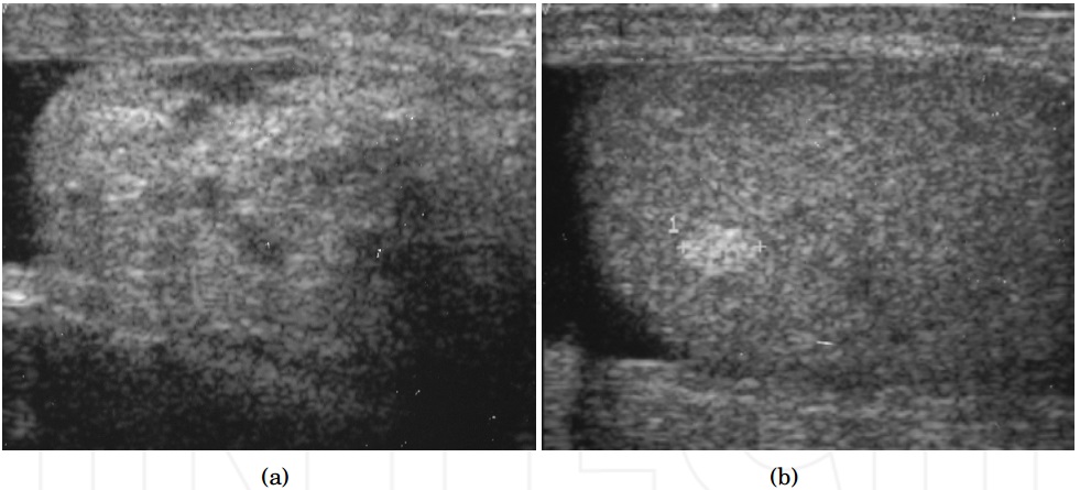 Ultrasound of a lipoma in two panels, a well-defined solid mass run through with fine streaks, calipers in the right panel.