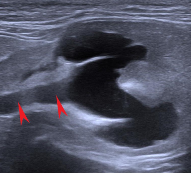 Ultrasound of hydronephrosis in a cat, the collecting space a dark pool, red arrows on the dilated ureter.