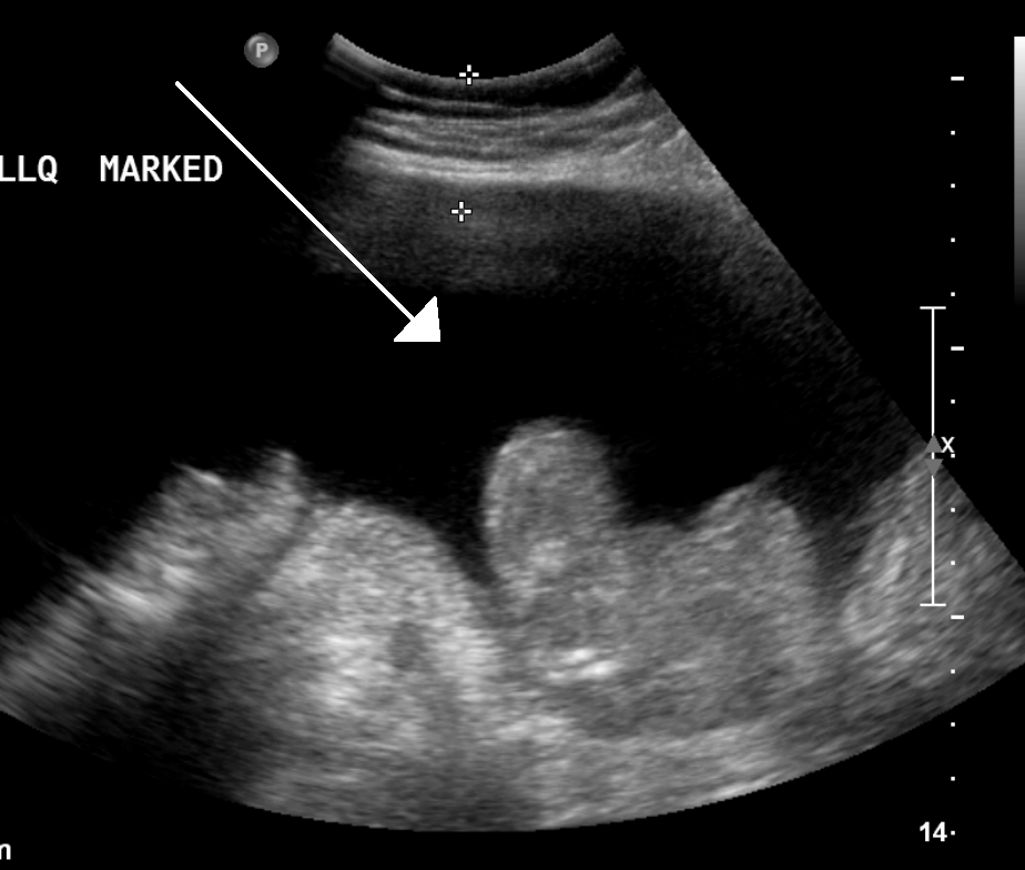 Abdominal ultrasound showing a large black pocket of free fluid with bowel loops floating in it, a white arrow pointing into the fluid.