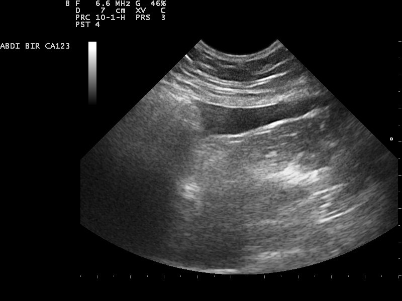 A curved-probe abdominal ultrasound, organs and tissue shown in grey, with machine settings labelled at the top.