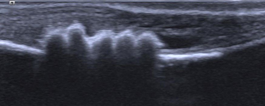 Canine ultrasound showing a row of bladder stones, each casting a dark acoustic shadow downward.