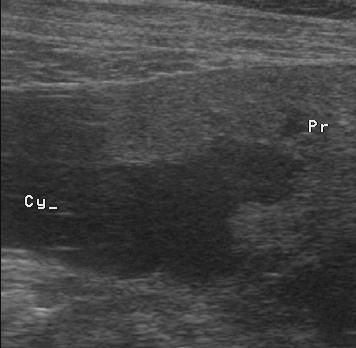 Canine abdominal ultrasound showing a large dark fluid-filled paraprostatic cyst beside the prostate.