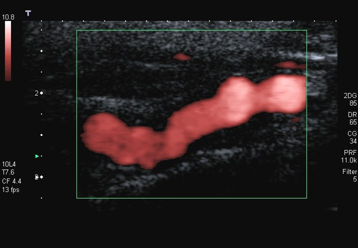 Power Doppler ultrasound of an artery filled with flow inside the sampling box
