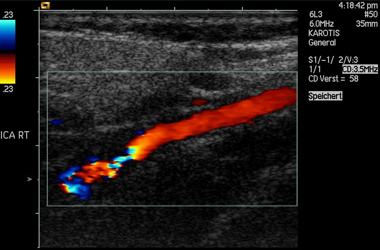 Color Doppler ultrasound of an artery filled with color flow over the gray picture