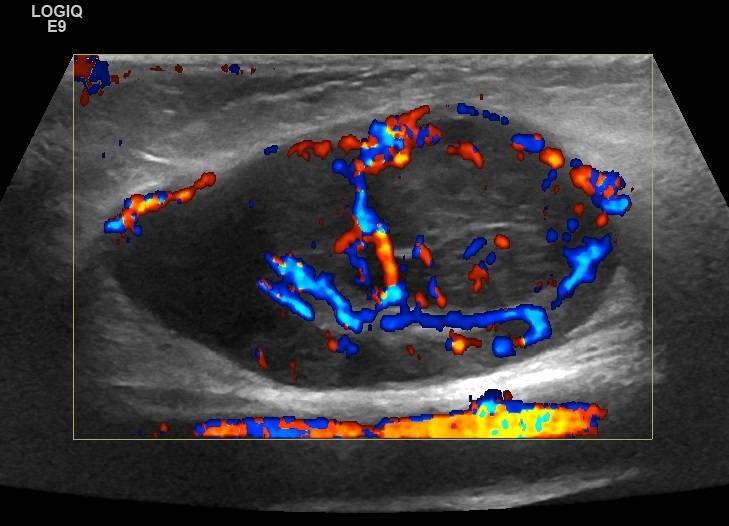 Color Doppler ultrasound of a lymph node with chaotic peripheral blood flow