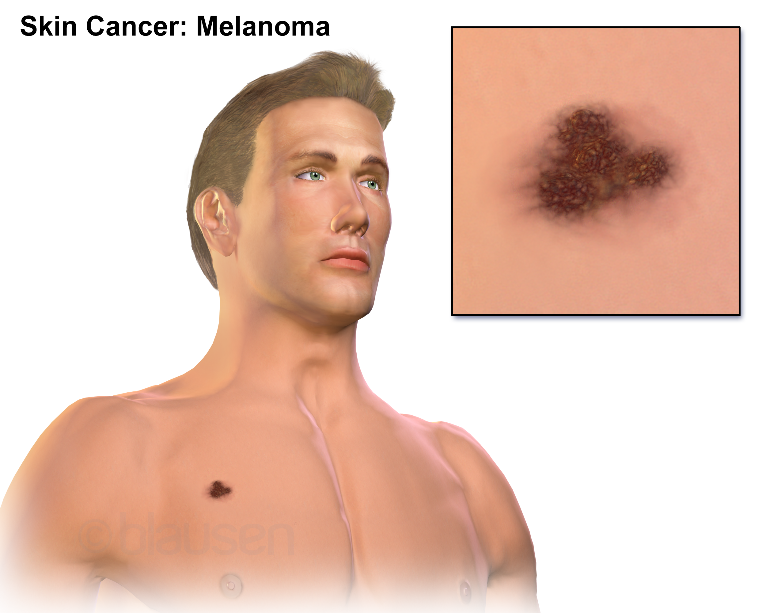 Illustration of a melanoma on the skin with a close-up of the lesion