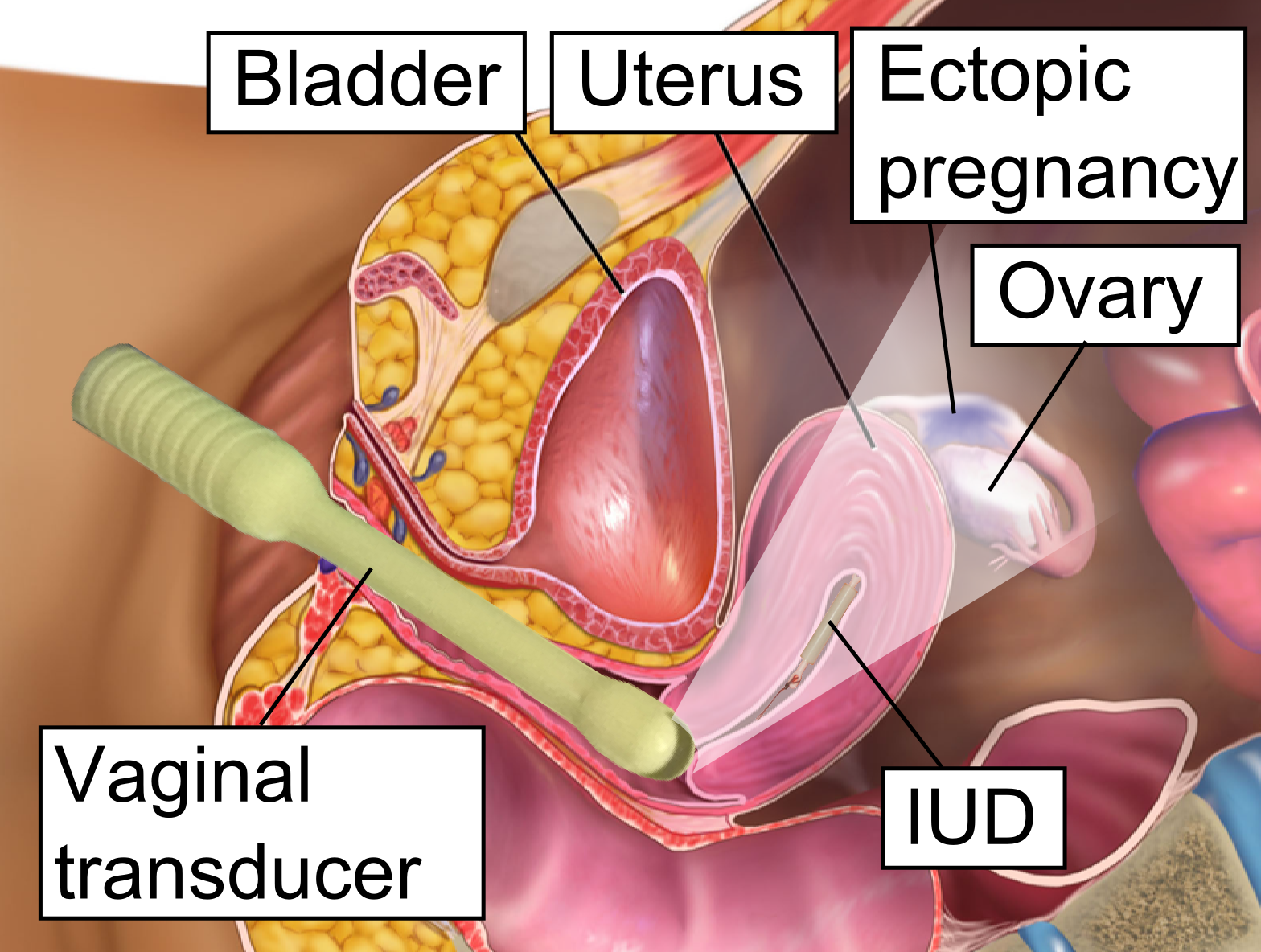 Schematic of a transvaginal transducer reading the uterus and an ectopic pregnancy beside it