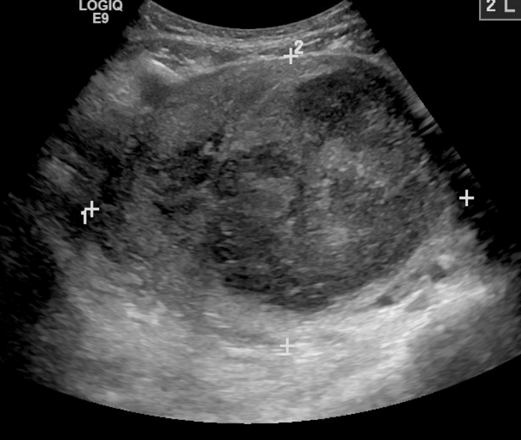 Ultrasound of a large fibroid measured whole on one screen with calipers