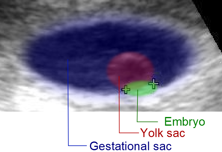 Early pregnancy ultrasound with gestational sac, yolk sac and embryo colored and labeled