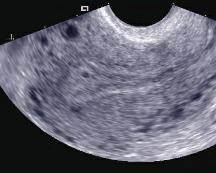Transvaginal ultrasound of a small early gestational sac in the uterine lining