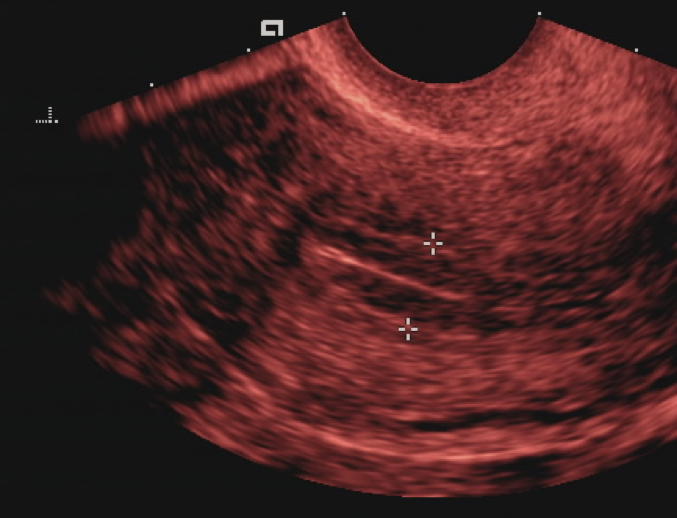 Transvaginal ultrasound of the endometrium with measurement calipers