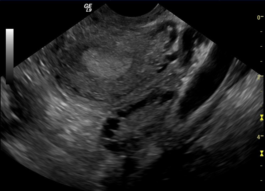 Transvaginal ultrasound of an ovary carrying multiple follicles