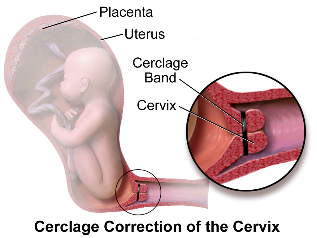 Medical illustration of a cervical cerclage stitch placed around the cervix