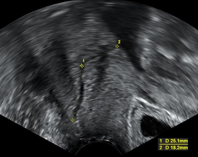 Transvaginal ultrasound of the cervix measured with calipers along the canal