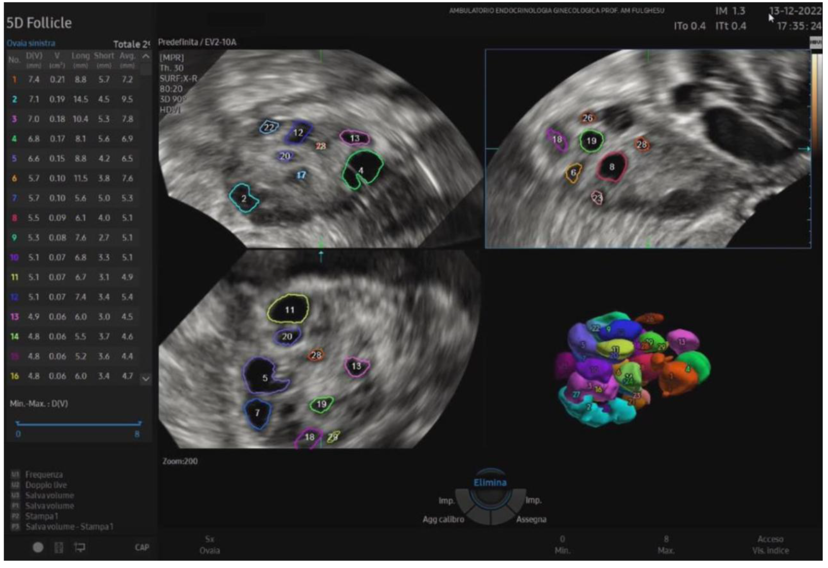 Follicle-mapping display of an ovary with numbered, measured follicles and a 3D rendering