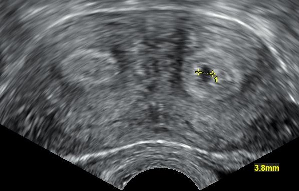 Transvaginal ultrasound holding the uterus in one wide pelvic field