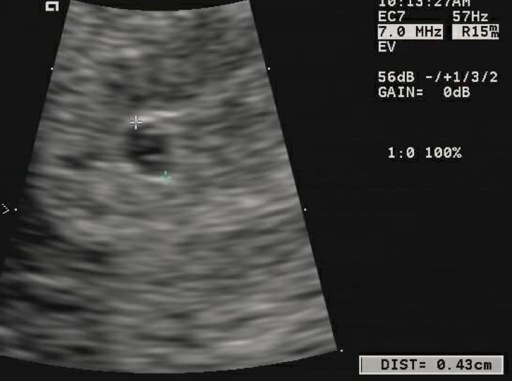 Transvaginal ultrasound of a four-millimeter gestational sac with measurement calipers