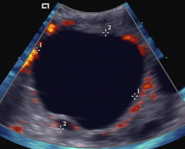 Transvaginal ultrasound of a mature ovarian follicle with calipers and rim color flow