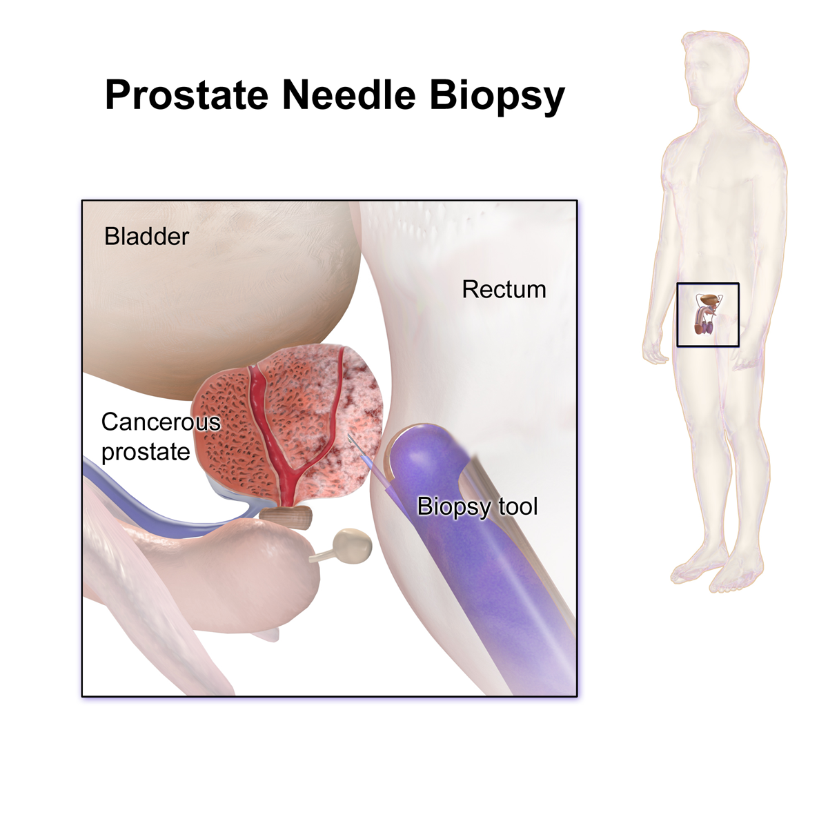 Diagram of a prostate needle biopsy: a probe in the rectum and a needle reaching the prostate