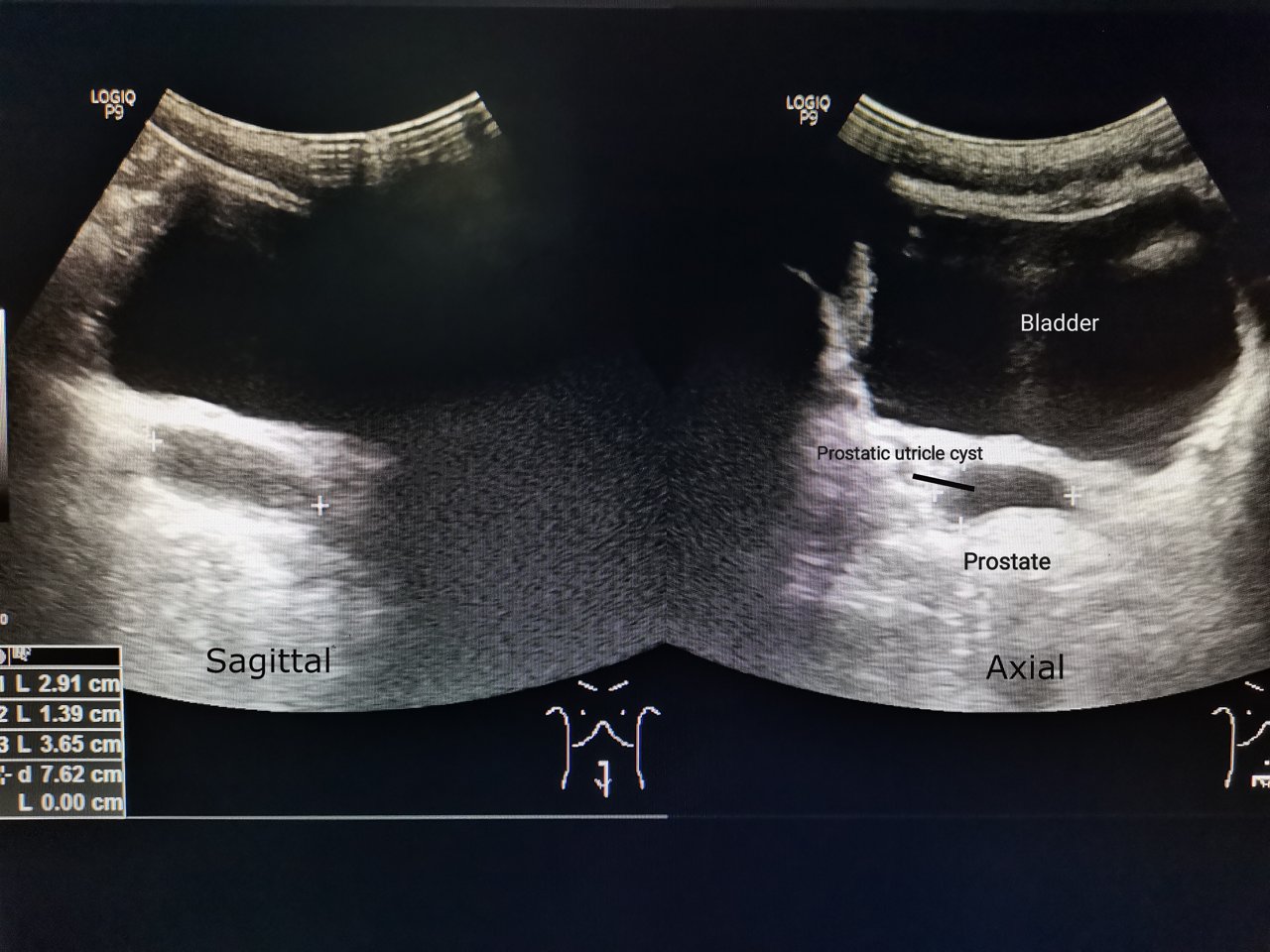 Transrectal ultrasound of the prostate in sagittal and axial planes