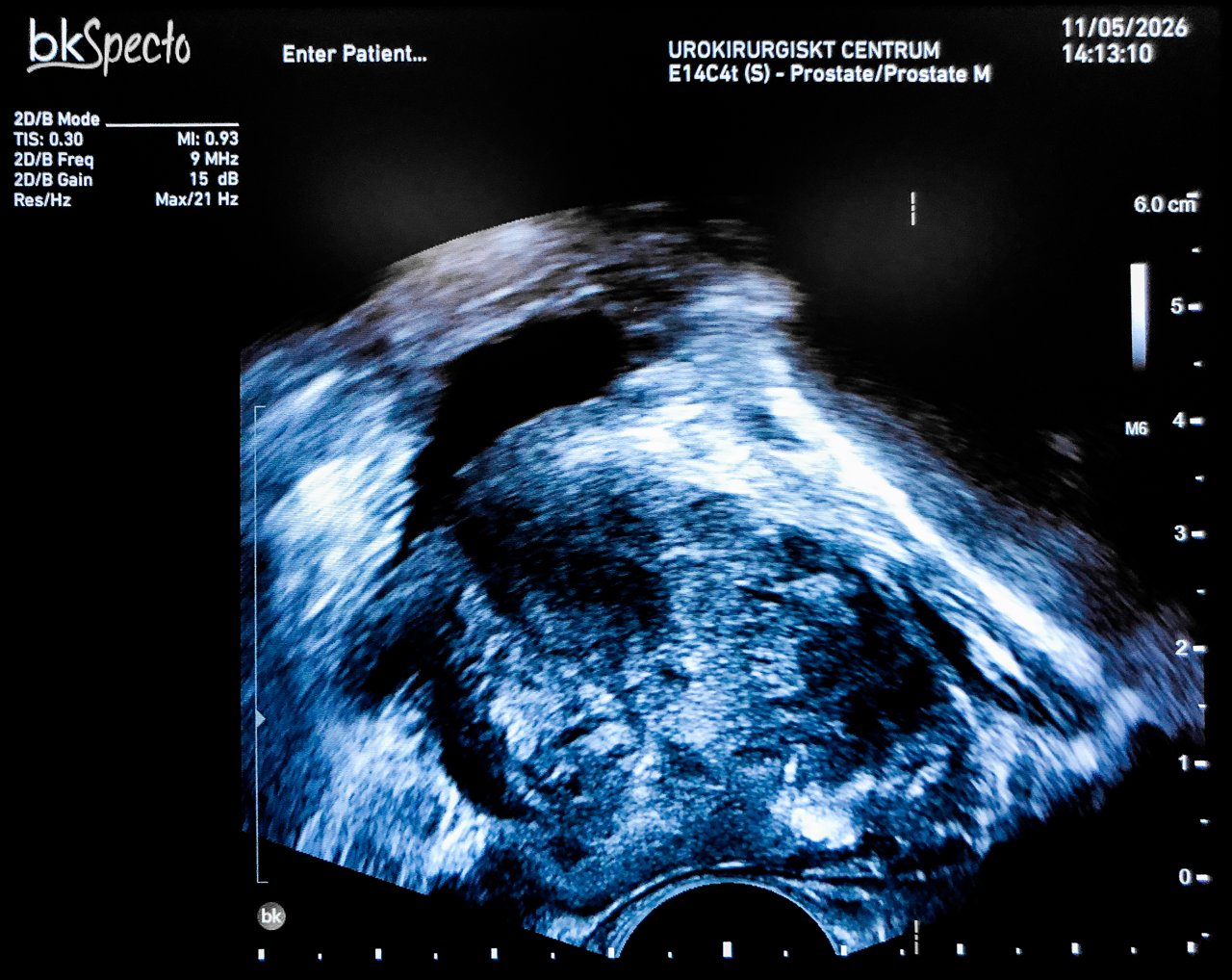 A prostate gland on a transrectal ultrasound scan
