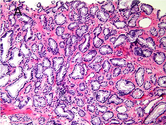 Micrograph of prostate cancer showing a low Gleason pattern of small glands