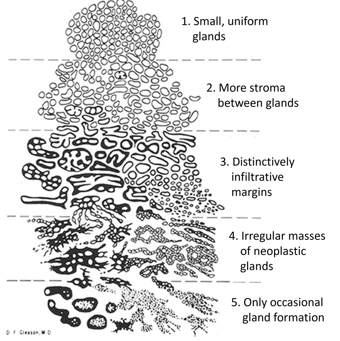 Diagram of the five Gleason patterns of prostate cancer